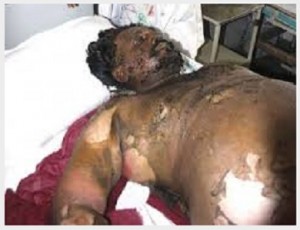 Ajit Poohla after being burnt [File Photo]